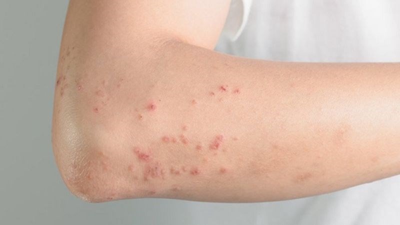 Vì sao bị ghẻ mãi không khỏi và làm thế nào để trị dứt điểm? 1