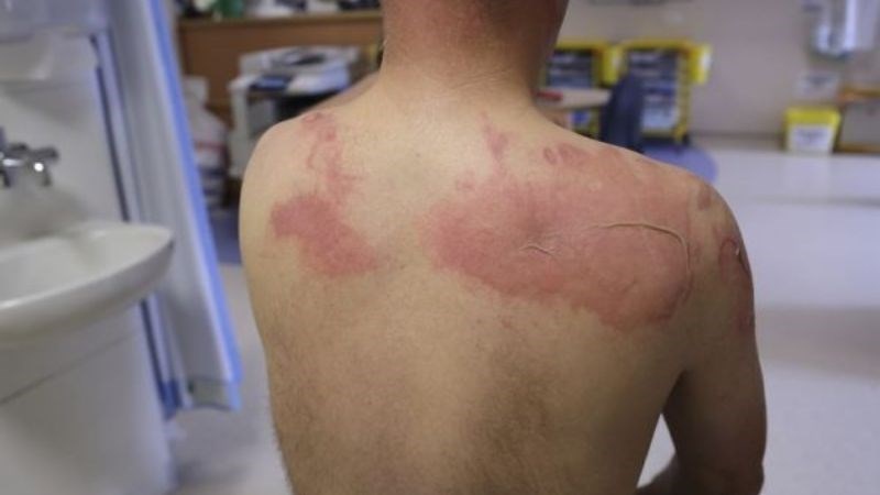 Cách xử lí viêm da do xạ trị ung thư 2