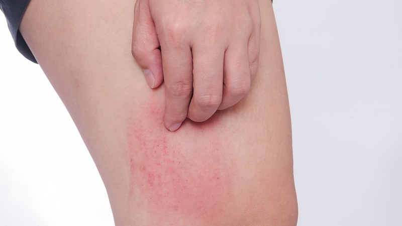 Cách xử lí viêm da do xạ trị ung thư 3