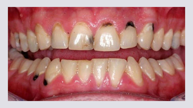 Vì sao chân răng bị đen và chảy máu? Cách ngăn ngừa và khắc phục 1