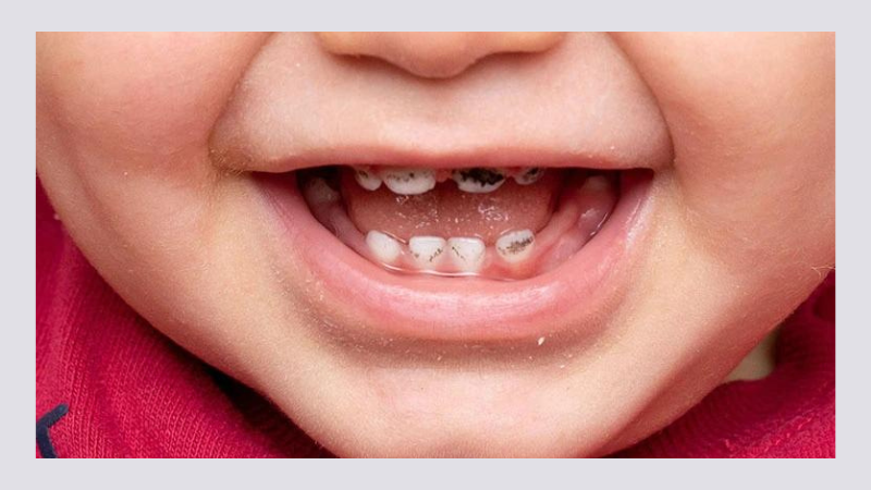 Vì sao chân răng bị đen và chảy máu? Cách ngăn ngừa và khắc phục 2