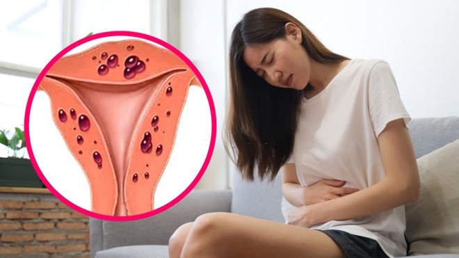 Vì sao lạc nội mạc tử cung gây vô sinh? 2