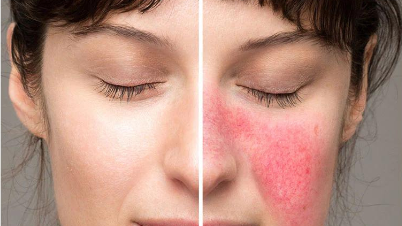 Vì sao peel da bị đỏ rát? Cách xử trí hiệu quả nhất 1