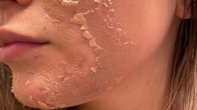 Vì sao peel da bị đỏ rát? Cách xử trí hiệu quả nhất 3