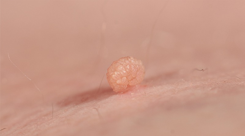 vi-sao-phai-tiem-ngua-hpv 2.jpg