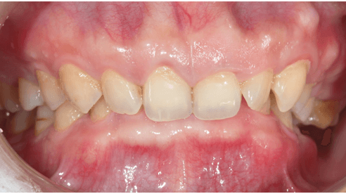 Vì sao sắp tháo niềng mà răng vẫn cụp? 2