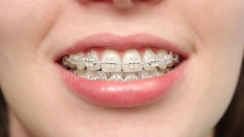 Vì sao sắp tháo niềng mà răng vẫn cụp? 3