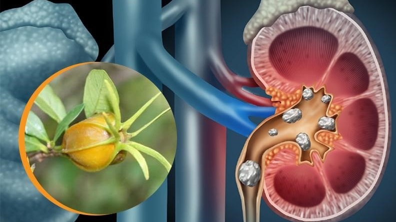 Vì sao sỏi thận gây tiểu buốt? Hướng phòng ngừa và điều trị an toàn 1
