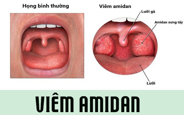Viêm amidan ở người lớn: Ít gặp nhưng chớ chủ quan! 4