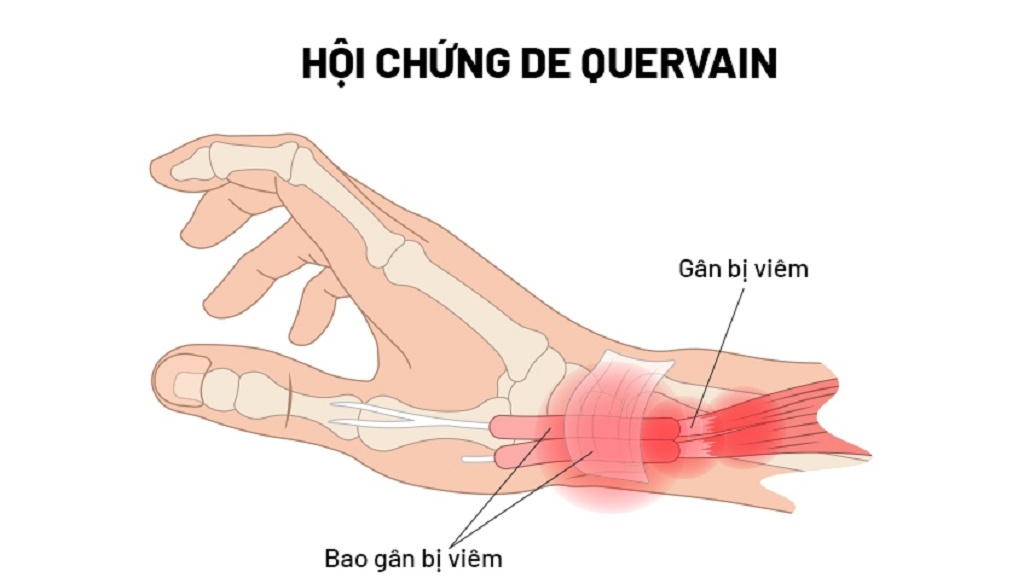 Hướng dẫn kiểm tra và điều trị hội chứng dequeven tại nhà