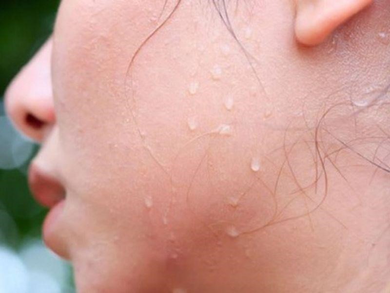 Viêm da mủ là bệnh gì? Viêm da mủ kiêng ăn gì nhanh khỏi? 7