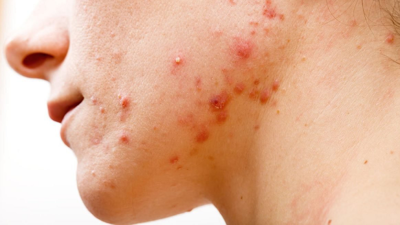 Viêm da mủ là bệnh gì? Viêm da mủ kiêng ăn gì nhanh khỏi? 1