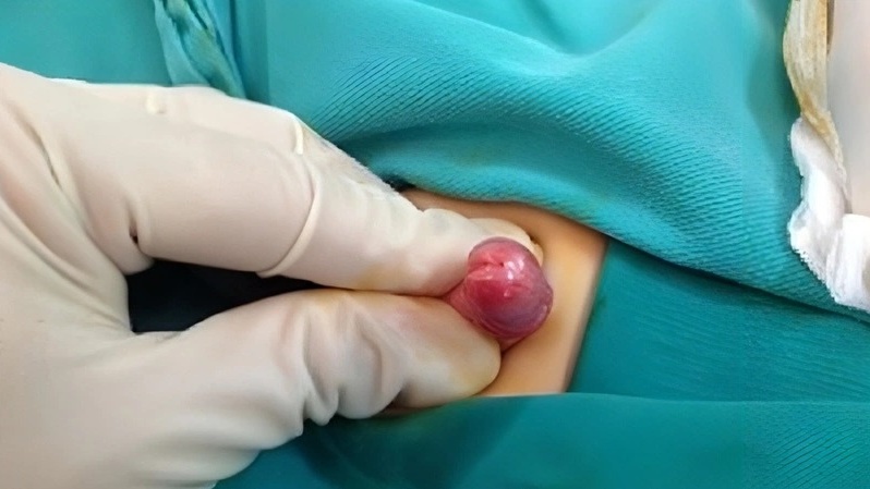 Viêm đầu dương vật: Nguyên nhân và phương pháp điều trị 1