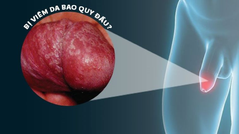 Viêm đầu dương vật: Nguyên nhân và phương pháp điều trị 2