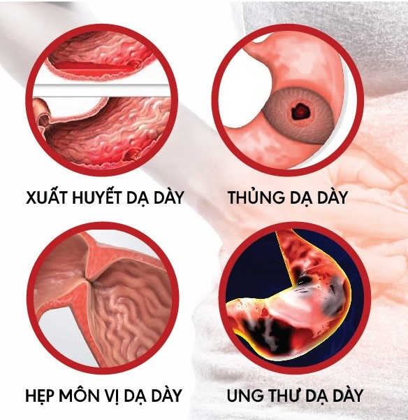 Viêm loét bờ cong nhỏ dạ dày nguy hiểm như thế nào? 4