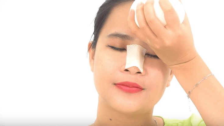 Viêm mũi dị ứng có nâng mũi được không? 2