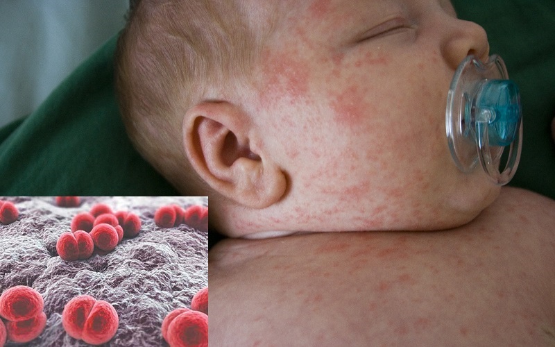 Viêm não mô cầu AC là bệnh gì? Cách phòng ngừa viêm não mô cầu AC 1