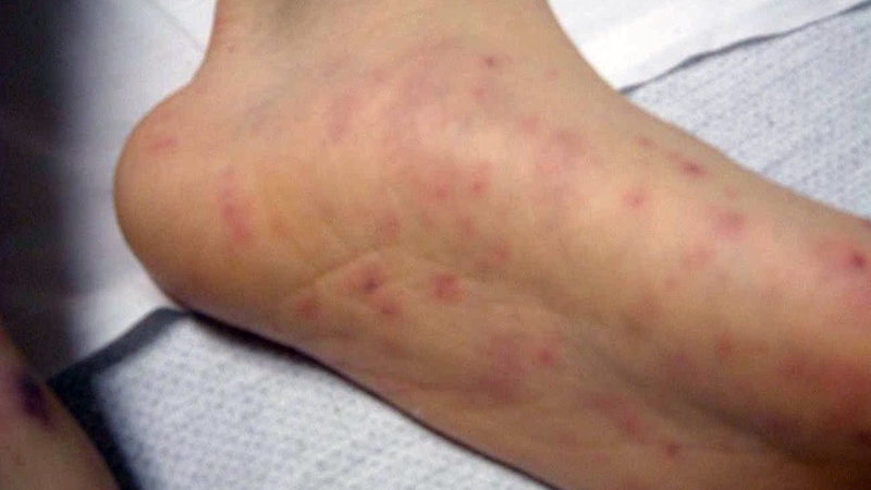 Viêm não mô cầu có nguy hiểm với người lớn không? Mức độ nguy hiểm ra sao? 1