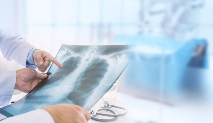 Viêm phổi PCP: Nguyên nhân, triệu chứng và cách điều trị hiệu quả 4