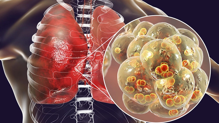 viem-phoi-thuy-la-gi-nguyen-nhan-va-trieu-chung-benh-ra-sao 1.jpg