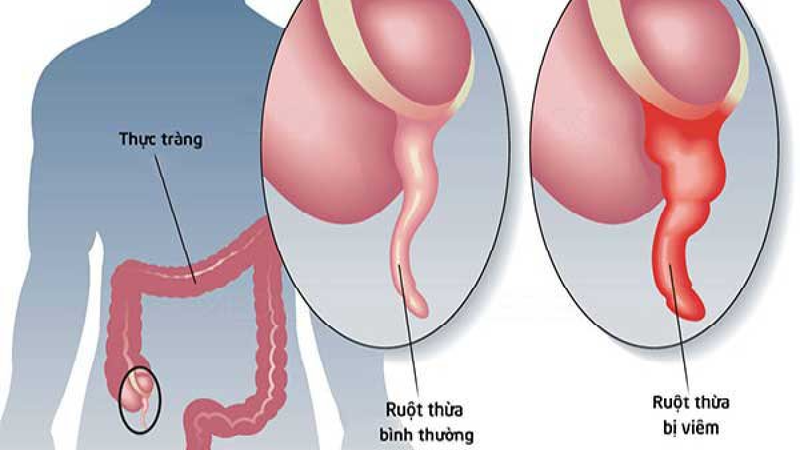 Viêm phúc mạc ruột thừa: Triệu chứng và cách điều trị 1