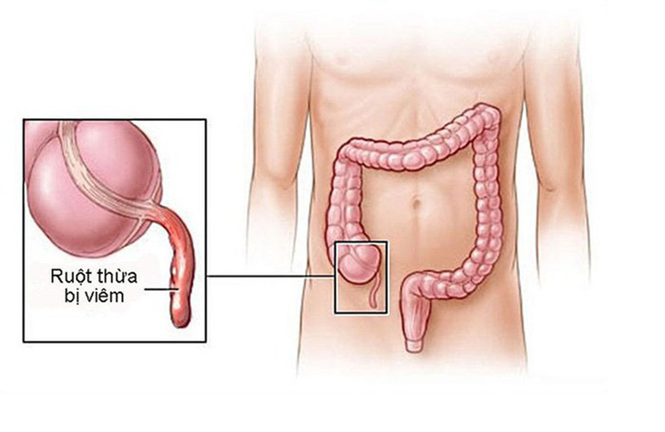 Viêm ruột thừa là gì? Phẫu thuật mổ ruột thừa bao lâu? 2