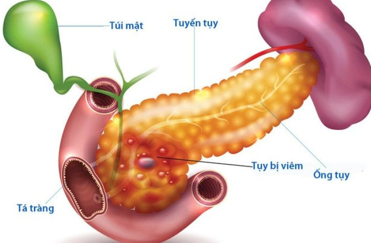 Viêm tụy là gì? Bệnh viêm tụy có gây nên men tụy cao không? 2