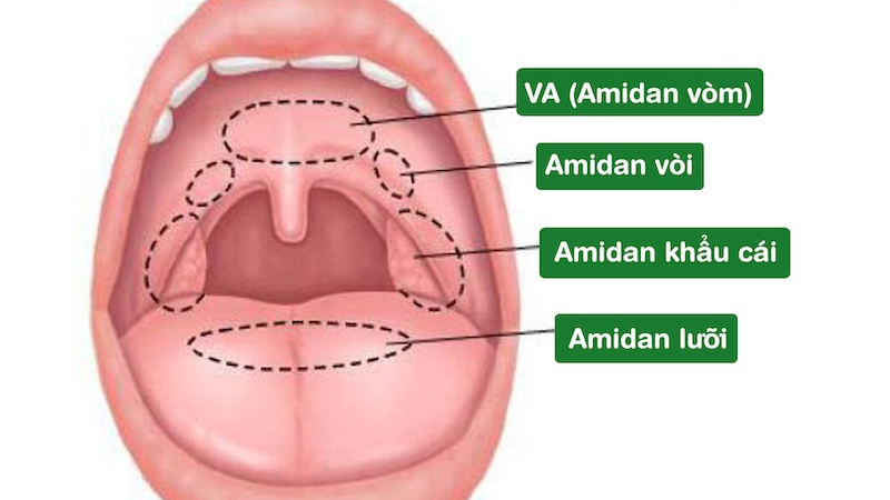 Hai giai đoạn viêm VA cấp tính và viêm VA mạn tính và cách điều trị 1