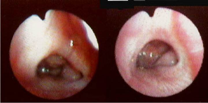 Viêm VA là gì và cách chăm sóc trẻ bị viêm VA 1