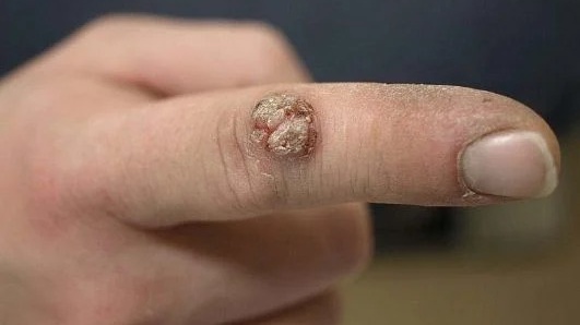 Virus HPV có ở đâu? Virus HPV tồn tại ngoài môi trường bao lâu? 3