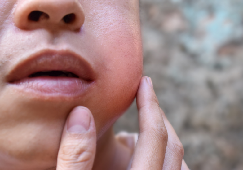 Virus quai bị: Những điều cần biết để bảo vệ sức khỏe bản thân và gia đình 2