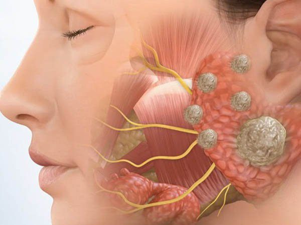 Vôi hóa tuyến nước bọt là bệnh gì? Có nguy hiểm không? 1
