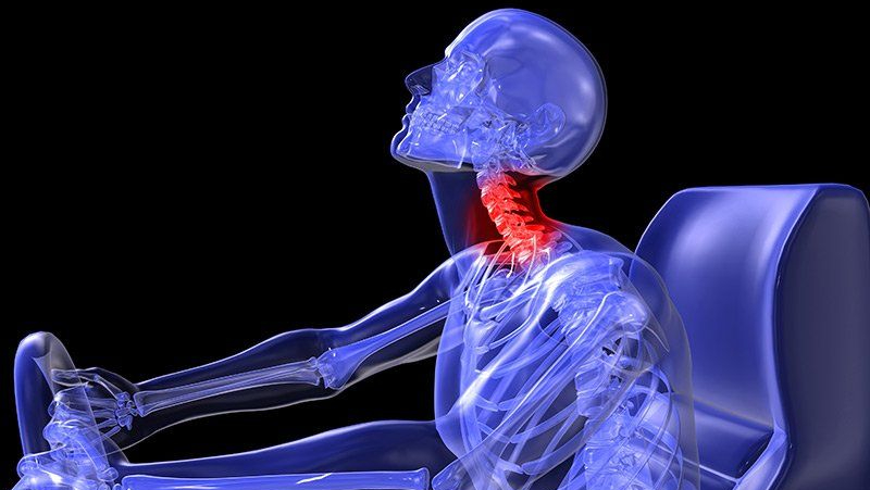 Whiplash là gì? Nguyên nhân, triệu chứng của chấn thương do giật cổ
