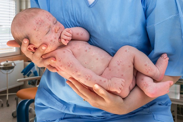 WHO cảnh báo hơn một nửa thế giới có nguy cơ bùng phát bệnh sởi vào cuối năm 2024-1