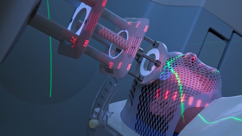 Xạ trị điều biến liều là gì? Ưu, nhược điểm và cách thực hiện phương pháp này 1