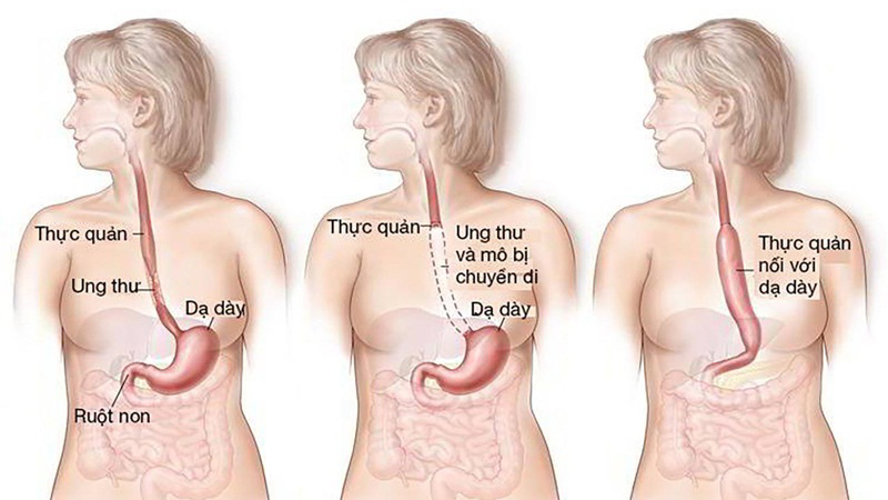 Xạ trị proton là gì? Bệnh nhân ung thư nào được chỉ định xạ trị proton? 5