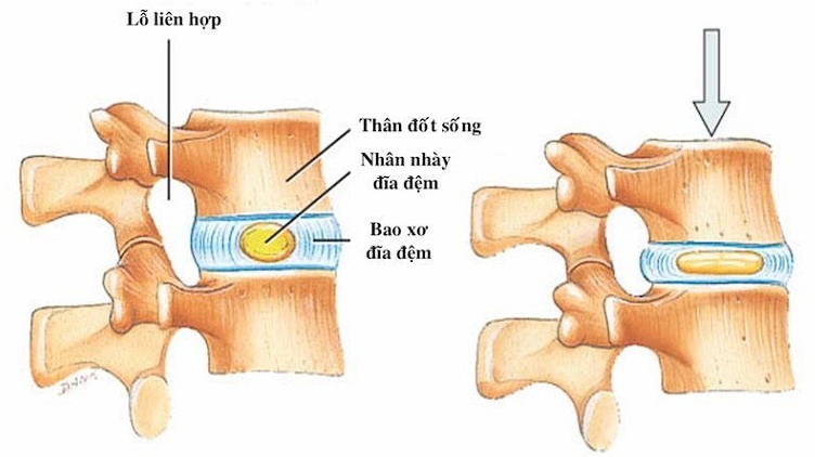 Xẹp đĩa đệm: Nguyên nhân, dấu hiệu và biện pháp phòng ngừa 1