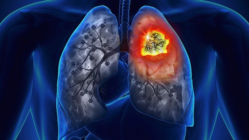 Xét nghiệm NSE là gì? Những điều cần biết 1