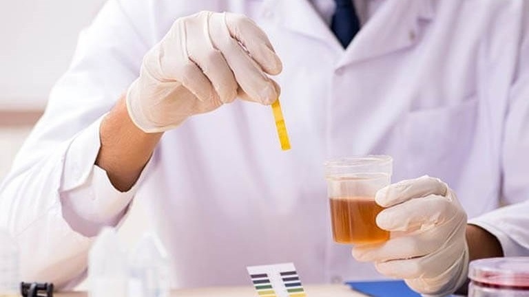 Xét nghiệm nước tiểu có phát hiện HIV không? 1