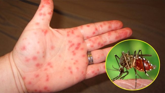 Xét nghiệm sốt xuất huyết ở đâu TP.HCM uy tín? 1