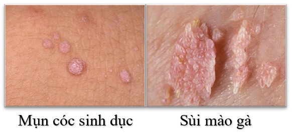 Xét nghiệm sùi mào gà ở đâu thì uy tín? 1