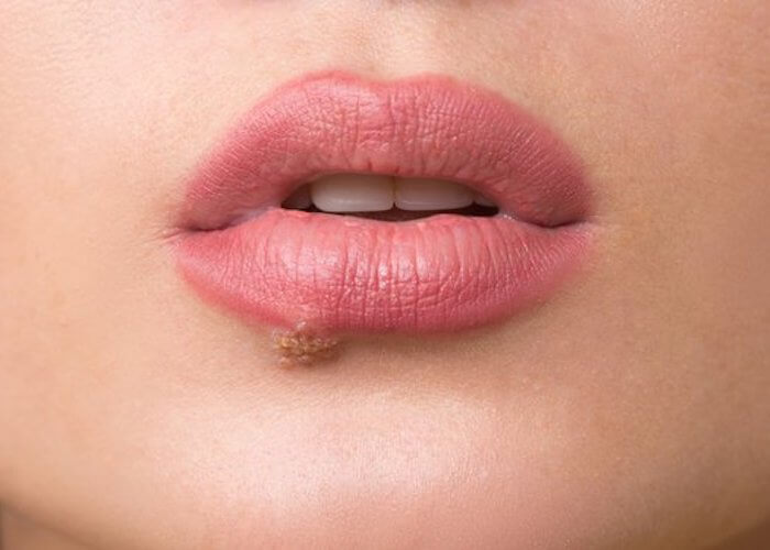 Xét nghiệm sùi mào gà ở đâu thì uy tín? 2