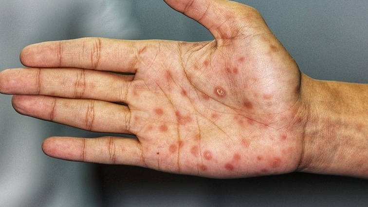 Xét nghiệm syphilis – Phương pháp sàng lọc bệnh giang mai hiệu quả 4