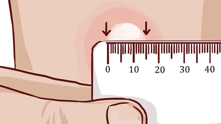 xet-nghiem-tiem-duoi-da-chan-doan-benh-lao 2.jpg