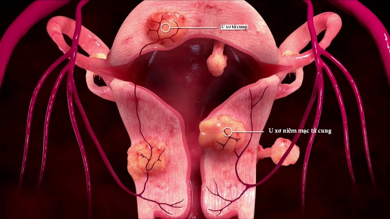 Xét nghiệm u xơ tử cung: Tầm quan trọng và cách đề phòng bệnh 2