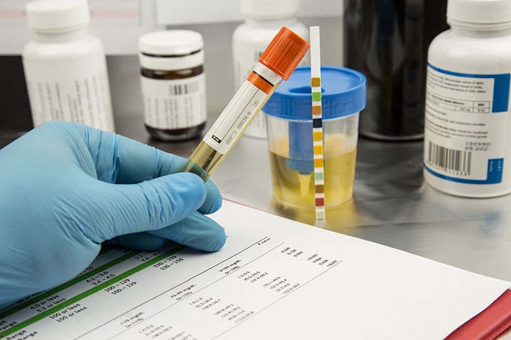 Xét nghiệm xeton là gì? Hướng dẫn đọc kết quả xét nghiệm xeton 1