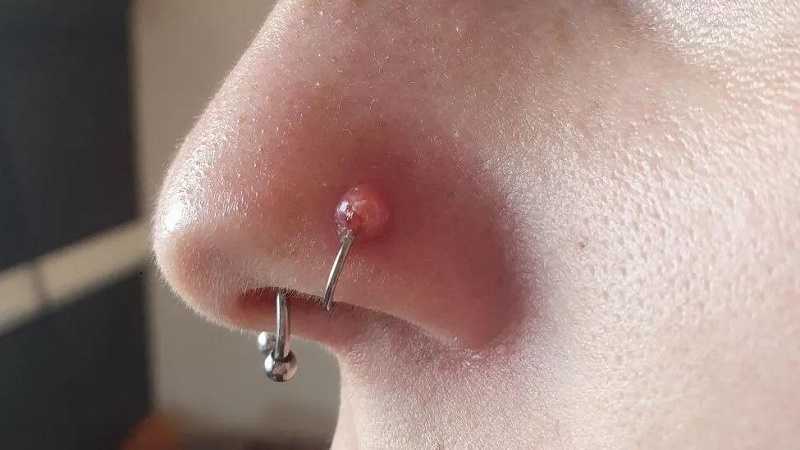 Xỏ khuyên mũi bị lồi thịt: Nguyên nhân, cách làm vệ sinh và lưu ý để ngăn ngừa 1