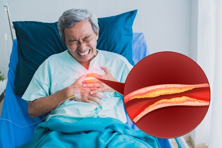 xo-vua-dong-mach-co-chua-duoc-khong 2.jpg