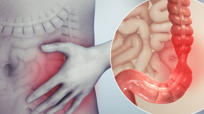 Xoắn ruột: Nguyên nhân, triệu chứng và cách điều trị 1