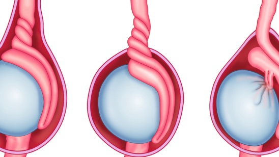 Phân loại xoắn tinh hoàn 3